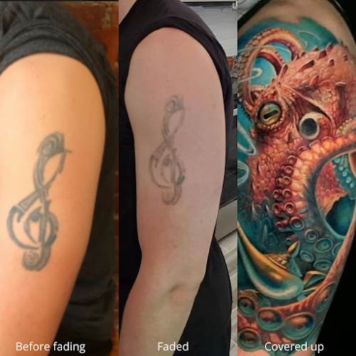 Removery Tattoo Removal & Fading tattoo shop in Philadelphia, Pennsylvania