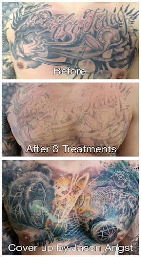 Removery Tattoo Removal & Fading tattoo shop in Pittsburgh, Pennsylvania
