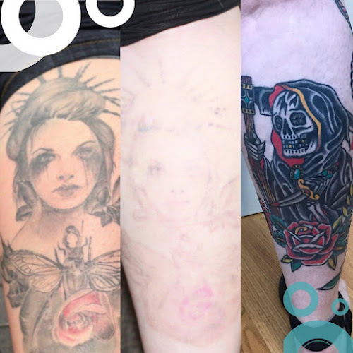Removery Tattoo Removal & Fading tattoo shop in Rochester, New York